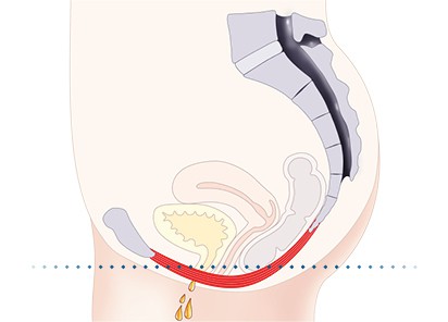 Pelvic-Floor Muscle Repair 5 Pelvic floor muscles Crawley Down